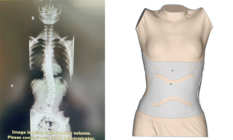 3d spine and IReal 2S health care.jpg